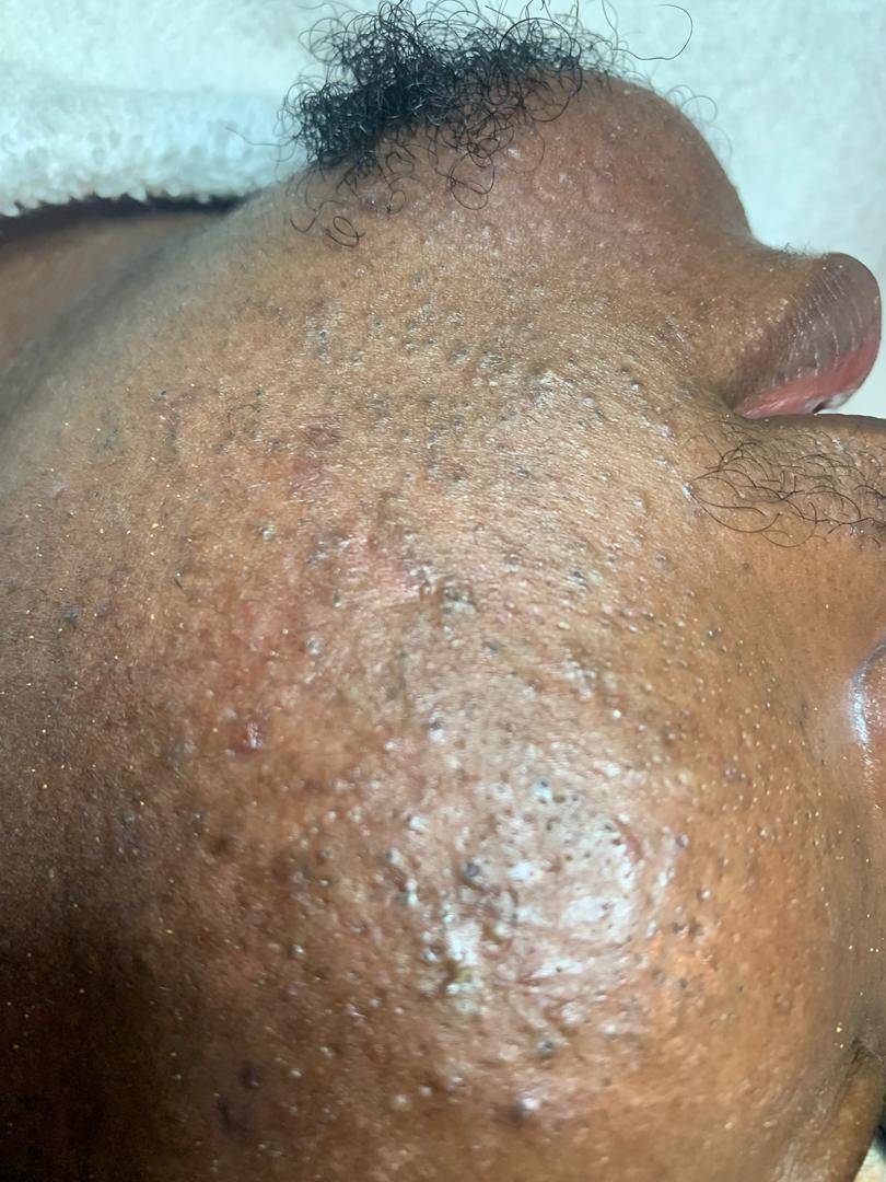 Before Facial Treatment